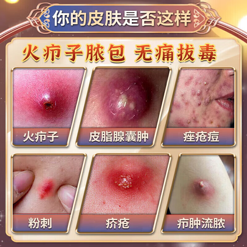 圣鑫堂火疖子吸脓贴消脓包疙瘩皮脂腺囊肿硬块火疖子专用软膏拔毒 特效买二送一【发三盒】秒拔疖子 鱼石脂消炎拔脓膏