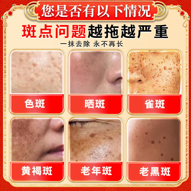 北京协和医学院祛斑霜老年斑专用特效非药一夜消去老年斑的药强力祛除手背部脸部 特效5盒膏【永久不犯】 医用净斑膏点斑药水除老年斑男士淡化黑色素日本进口