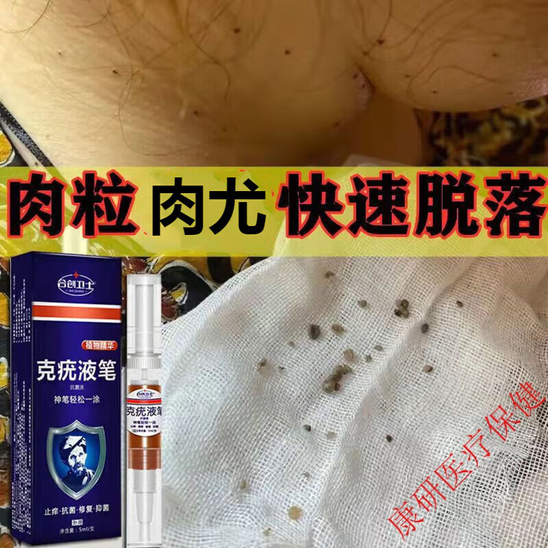 【官方直售】疣液扁平疣脸部疣瘊平除l疣立净去猴子肉粒去刺猴丝状疣