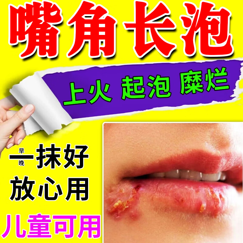 红霉素软膏婴儿嘴角溃烂软膏口角炎消炎私处止痒杀菌药膏阴部瘙痒私处