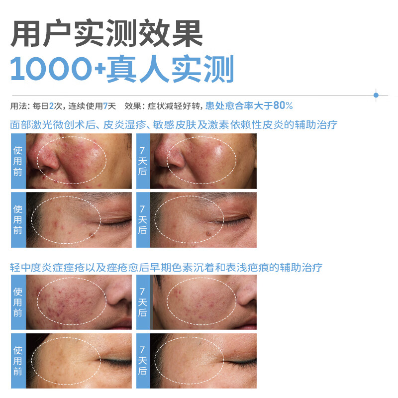 益肤【械字号】医用透明质酸敷料微创术后炎症痤疮皮炎湿疹非面膜蓝膜 2片