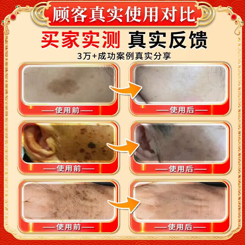 北京协和医学院祛斑霜老年斑专用特效非药一夜消去老年斑的药强力祛除手背部脸部 特效5盒膏【永久不犯】 医用净斑膏点斑药水除老年斑男士淡化黑色素日本进口