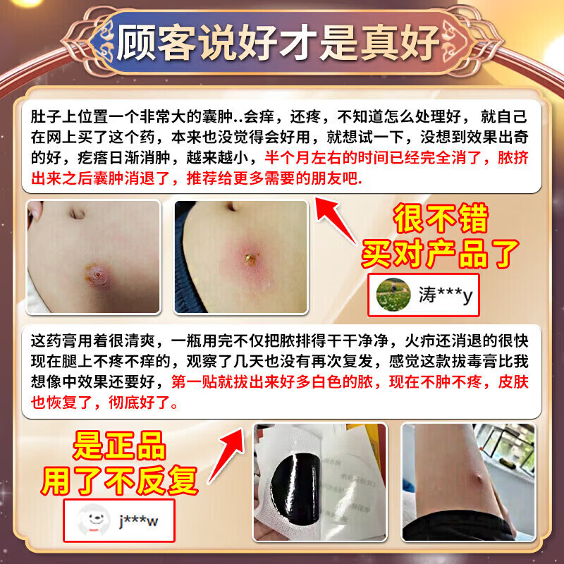 圣鑫堂火疖子吸脓贴消脓包疙瘩皮脂腺囊肿硬块火疖子专用软膏拔毒 特效买二送一【发三盒】秒拔疖子 鱼石脂消炎拔脓膏