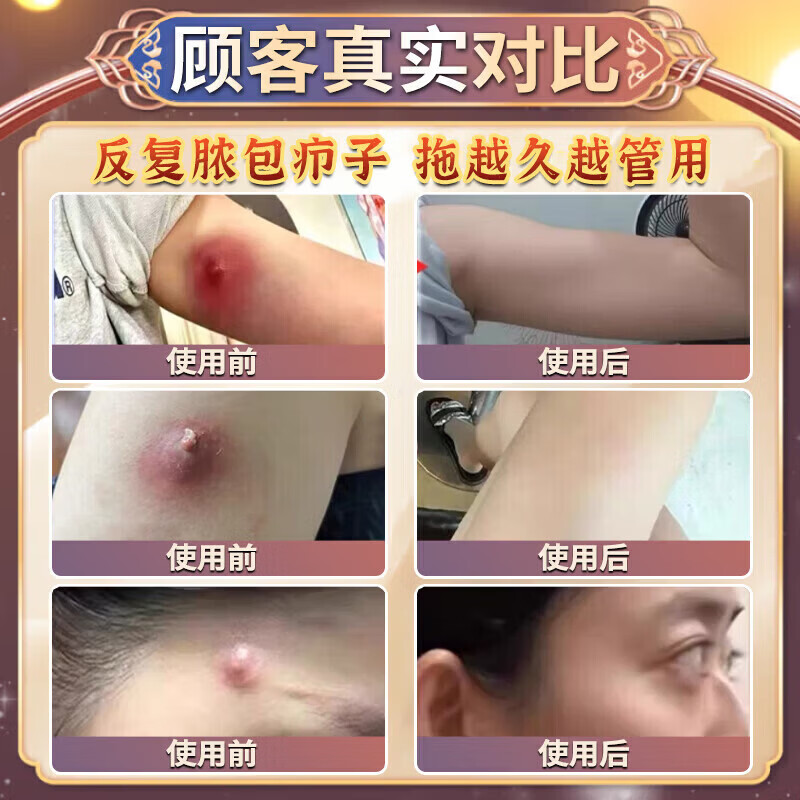 圣鑫堂火疖子吸脓贴消脓包疙瘩皮脂腺囊肿硬块火疖子专用软膏拔毒 特效买二送一【发三盒】秒拔疖子 鱼石脂消炎拔脓膏