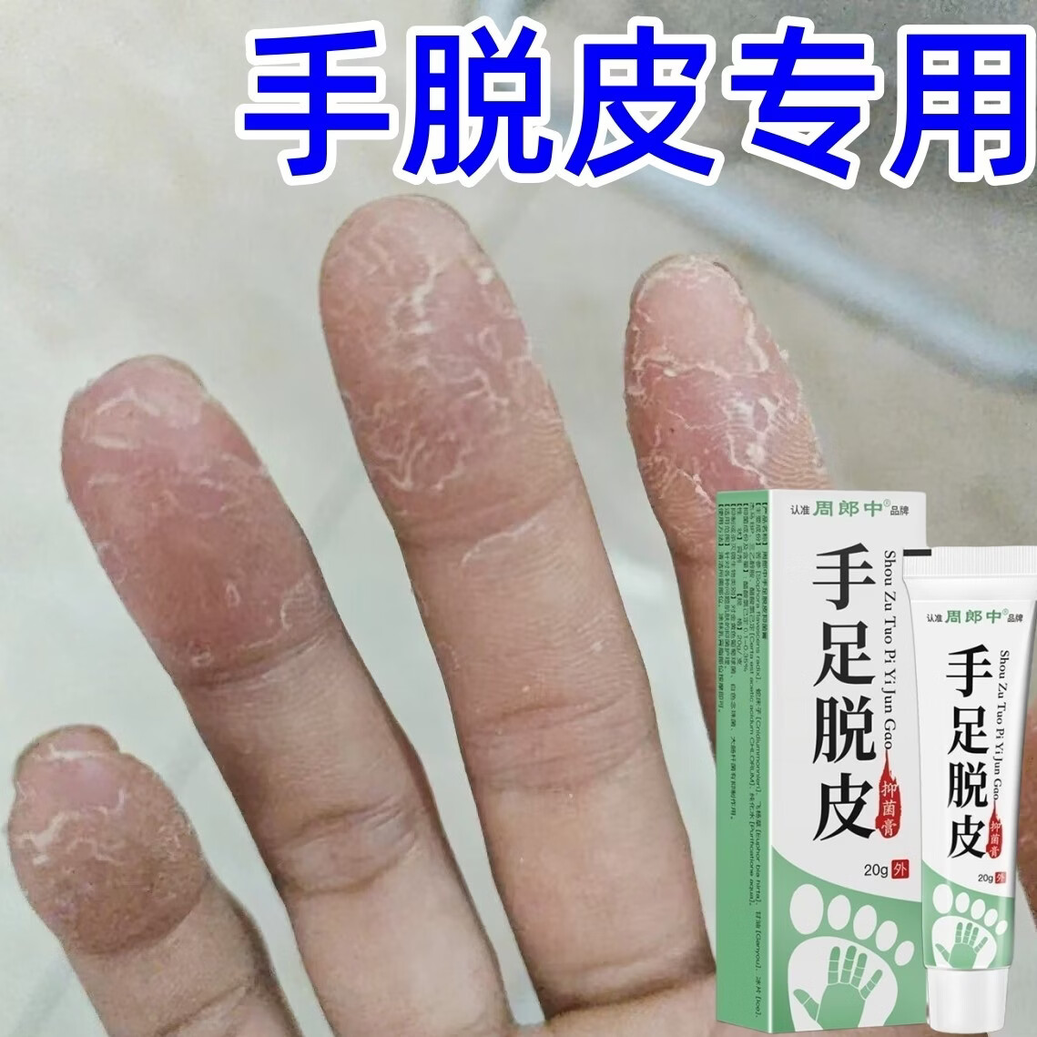 周郎中手足脱皮膏手脱皮开裂干裂止痒干脱皮手脚脱皮专用修复护理 到手5盒装【正品保障多送两盒】早晚各涂抹一次