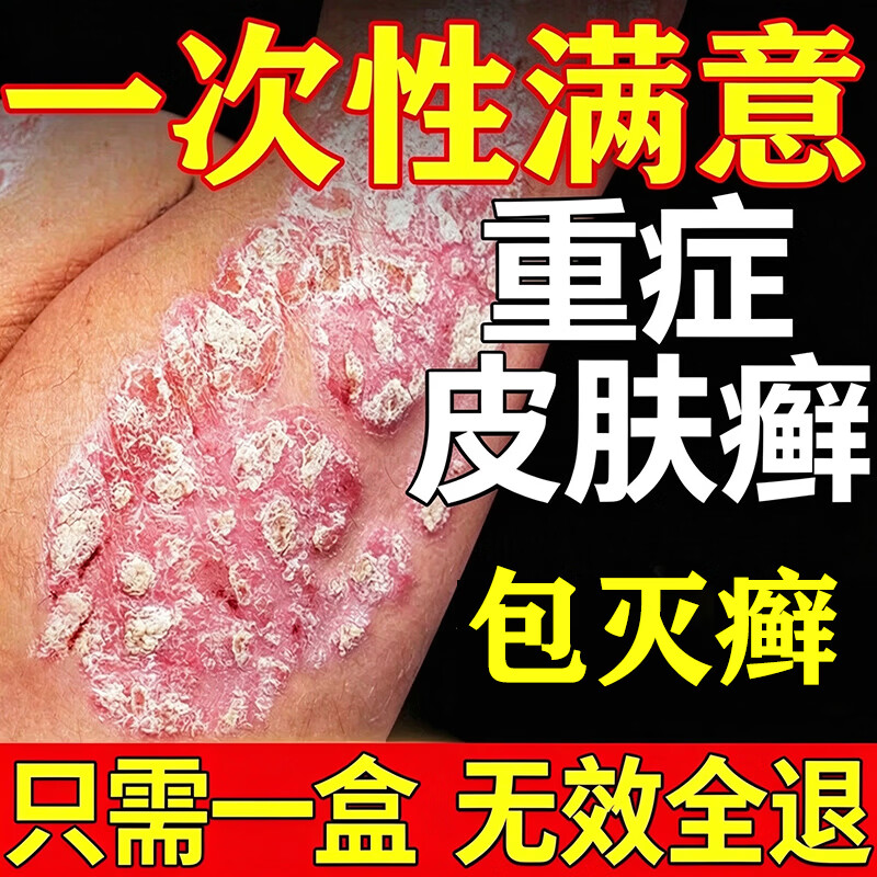 岩井昃弘牛皮断病根药皮肤癣膏药真菌止痒抑菌皮肤顽固牛皮皮膏药进口 买三送二【巩固装】真菌王 牛皮皮肤癣专用特强效膏 京东折扣/优惠券