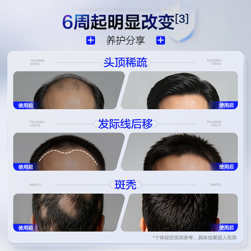 [杰士邦]米诺地尔搽剂 5%*60ml 1盒装 5%*60ml*1瓶