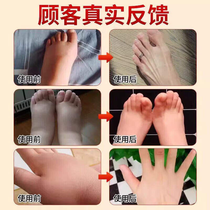 邹润安脚肿消肿喷药老年人水肿喷剂治老人去下肢浮肿脚踝肿胀专用喷雾剂 5盒装