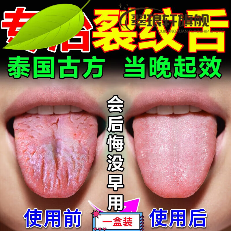 舌头裂纹有齿痕舌苔白厚刮舌头神器地图舌调理儿童灼口症治嘴烂药 1