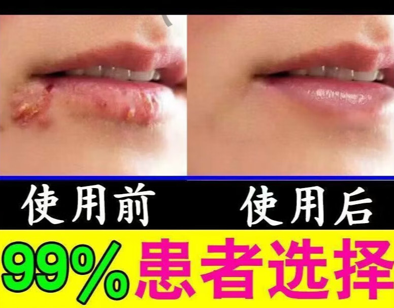 上火起泡嘴唇 烂嘴巴 嘴角水泡长痘裂缝 脸部脓包肿痛瘙痒 膏f 一瓶装