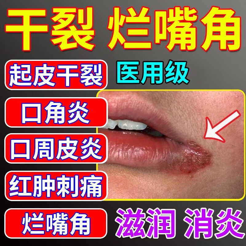 唇炎专用药慢性唇炎嘴唇干裂医用级嘴角溃烂软膏口角炎烂嘴角药成人