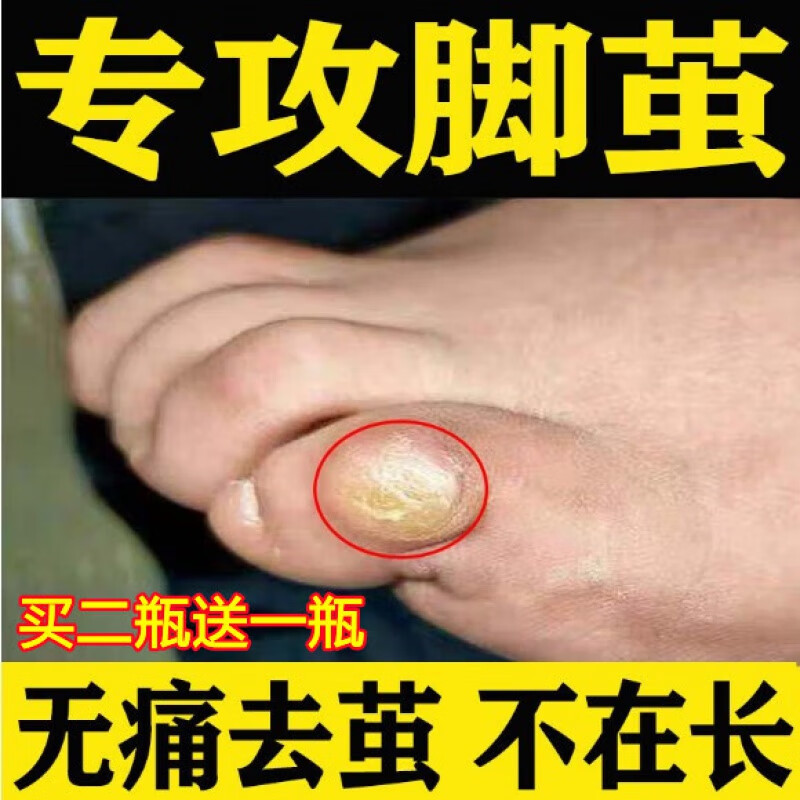 【官方直售】祛老茧脚茧手脚趾脚底死皮关节茧软化剂去除脚垫的药胼胝