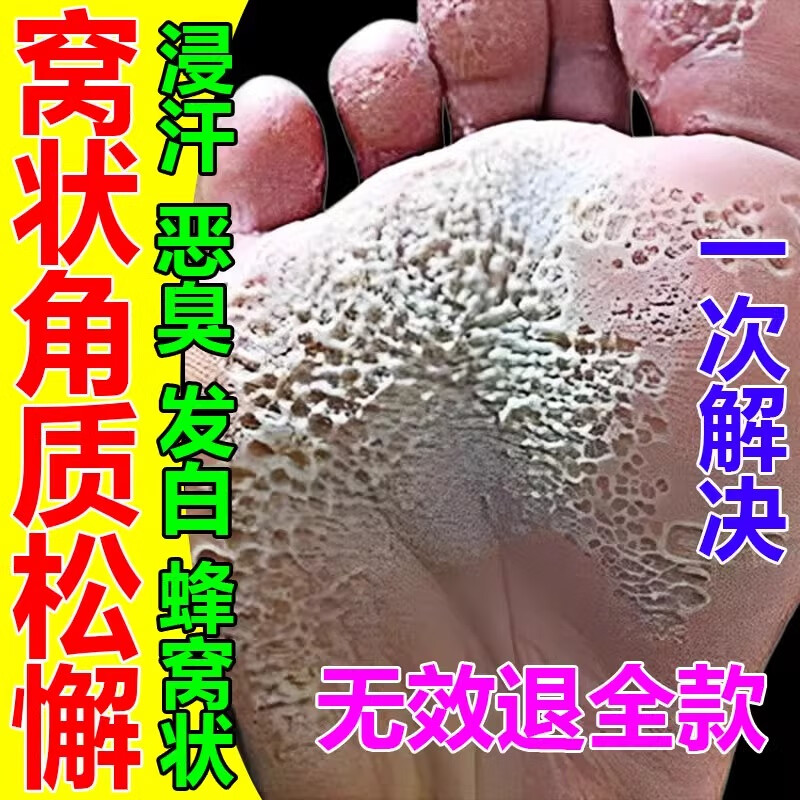 窝状角质松解症专用脚底真菌感染脚底发白糜烂臭蜂窝状沙虫脚气骚痒