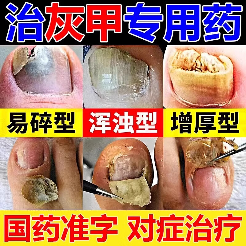 正品灰指甲抑菌真菌感染脱甲坏甲皮肤用药亮甲 达克宁硝酸咪康唑乳膏