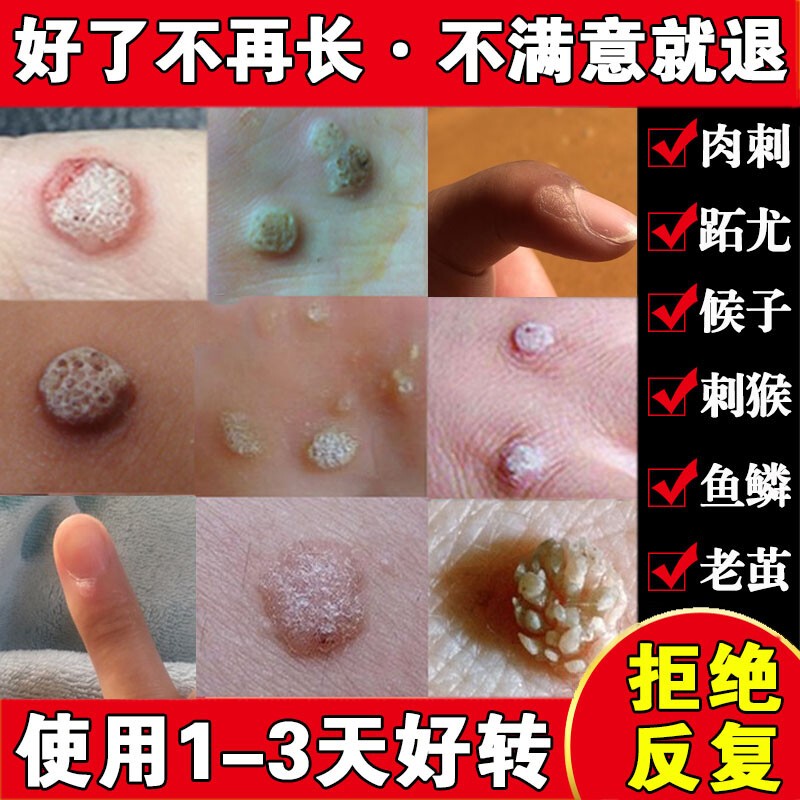 京健康子的药鱼鳞痣祛肉粒疙瘩治瘊子休子药刺猴药去除 刺猴药去除