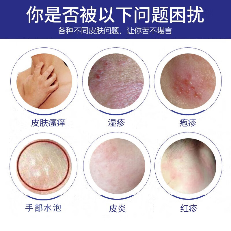 非去皮肤真菌感染外用根手部水泡孕妇瘙痒药房房儿童皮夏炎热监审批