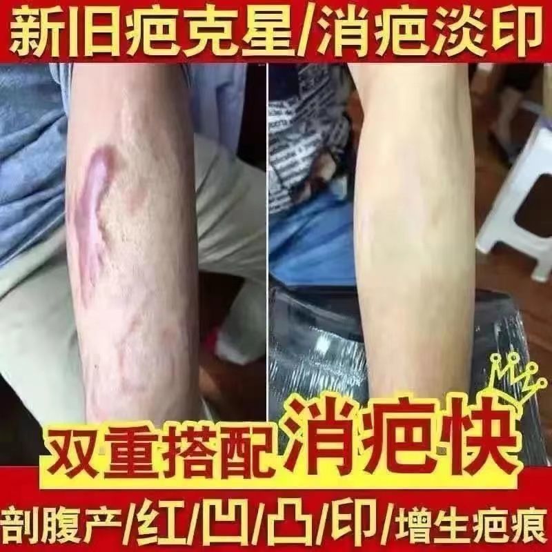 烫伤疤剖腹产摔伤手术伤刀疤痘印痣印烫伤疤痕双眼皮修护膏 588倍效
