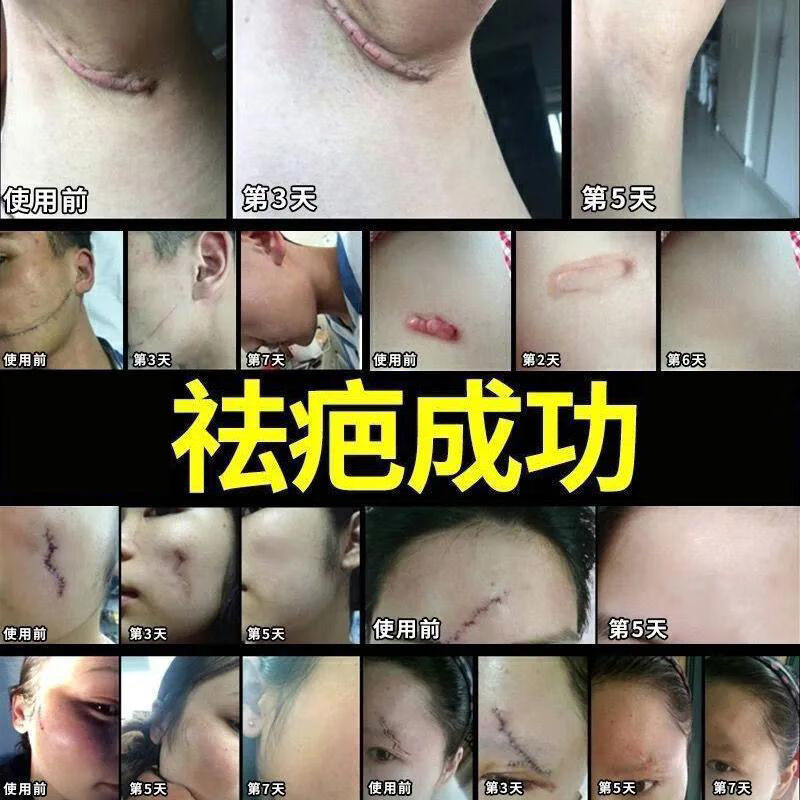 【疤痕修护膏】男女去疤膏手术伤疤旧疤黑色素祛痘印修复烫伤膏 疤痕