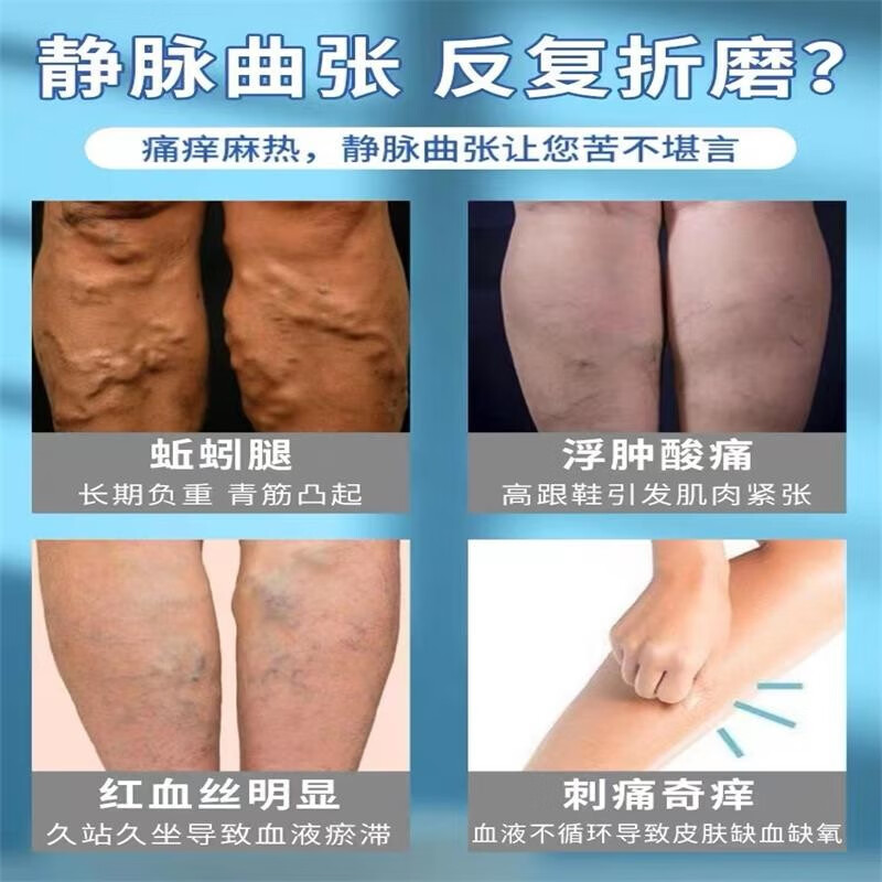 静脉曲张专用膏药贴静脉炎贴青筋血管凸起曲张红血丝蚯蚓腿肿胀膏下肢腿部酸胀疼痛麻木贴 3盒