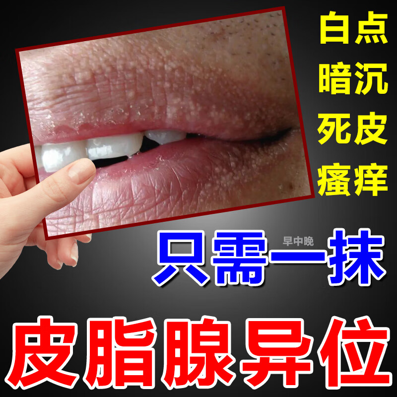 皮脂腺异位症嘴唇白点增生嘴唇迷脂症疱诊毒疹旺盛干 单盒【体验装】