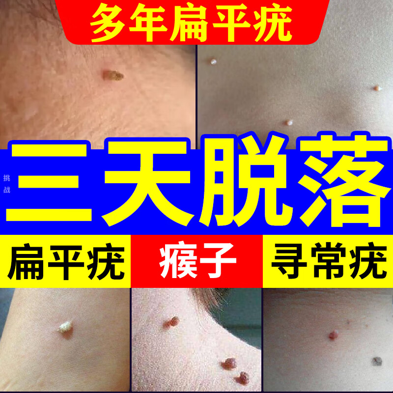 五妙水杨酸软膏水仙国药准字号扁平疣专用药膏祛疣瘊子扁平疣去脖子上