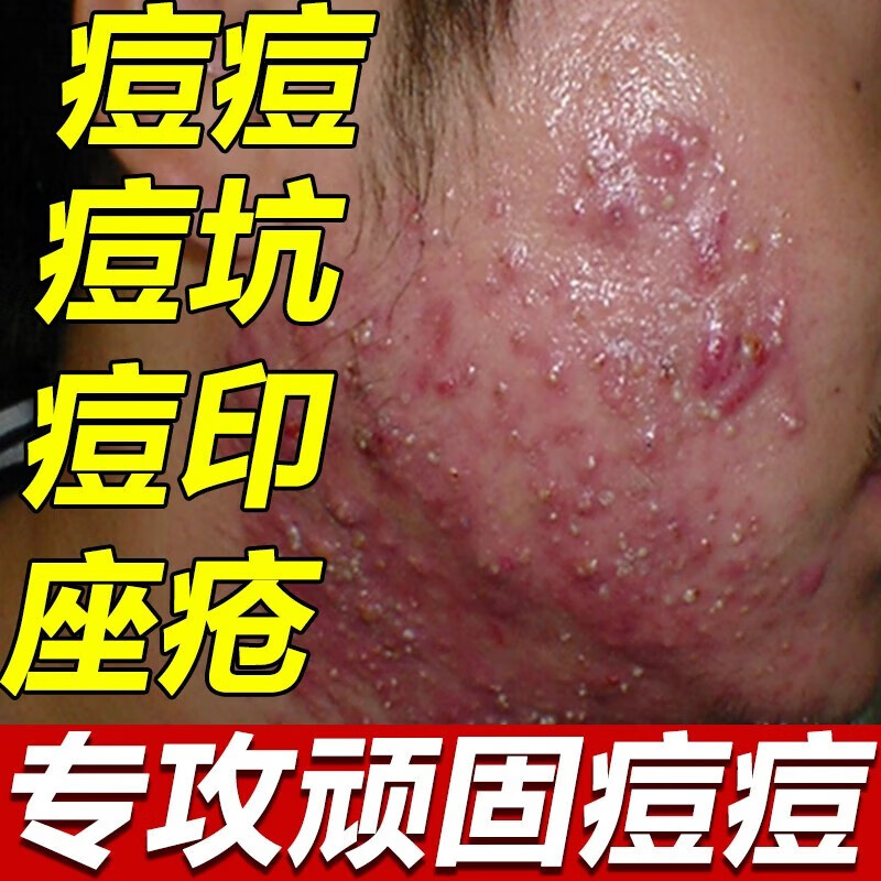 仁和匠心 水杨酸多效祛痘平衡霜祛痘膏细致毛孔去淡化痘印痘疤痘坑青春痘 3支装【周期疗程装】