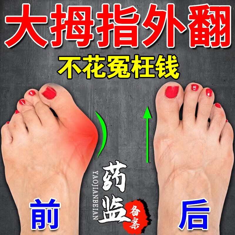 拇指外翻贴脚趾变形大脚趾骨突出外露肿胀疼痛变形重叠专用贴 单盒