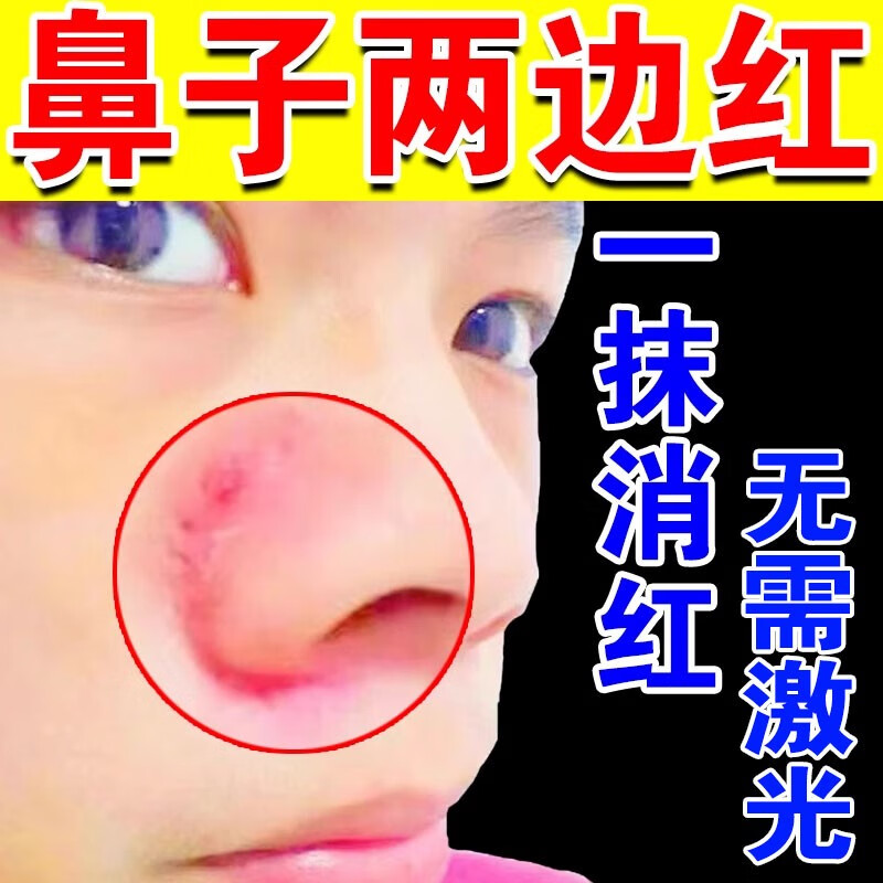 酒糟鼻修复红鼻子草莓鼻修复鼻部l红血丝红鼻头酒渣l鼻毛孔男女 单