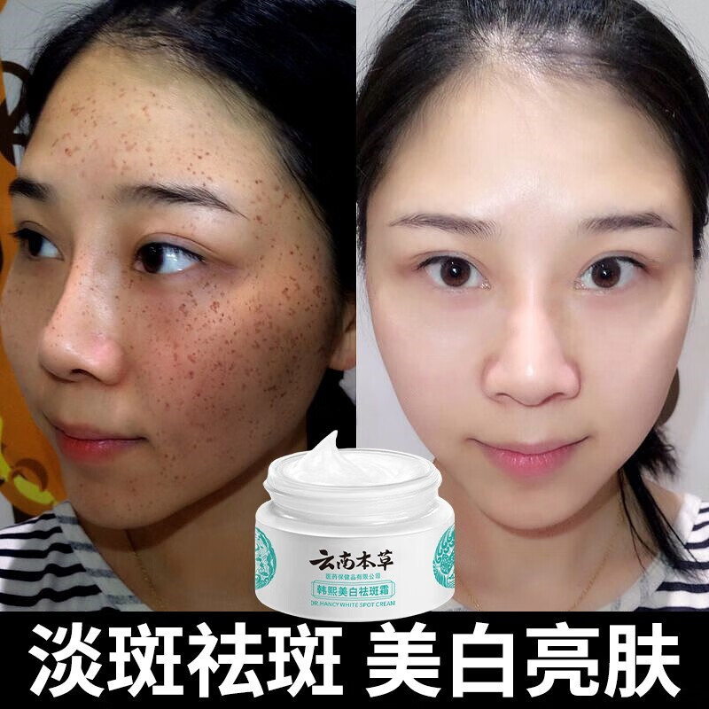 氢醌乳膏 黄褐斑雀斑蝴蝶斑妊娠斑晒斑老年斑咖啡斑真皮色素沉淀美白