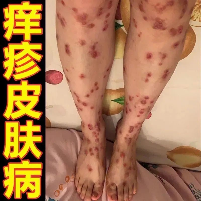 黎维莎结节性痒l疹专用苔藓百草止痒膏手脚顽固性全身结节性疙瘩出脓