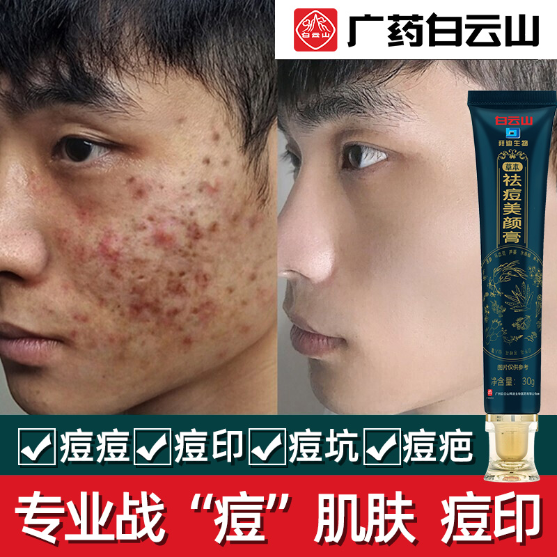 莜凡丽白云山草本祛痘膏30g 淡化痘印痘疤痘坑舒缓呵护青春痘暗疮粉刺痘痘膏去痘霜