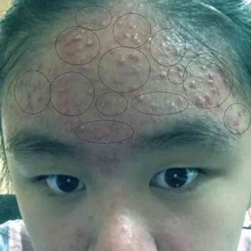 额头上长痘痘脸上长痘痘内分泌失调祛痘印痘坑粉刺闭口长痘祛痘膏祛痘
