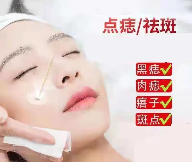 点斑水 点痣水去痦子无痣脱痣去脸上的黑痣去痣贴 点痣水一瓶点痣点 