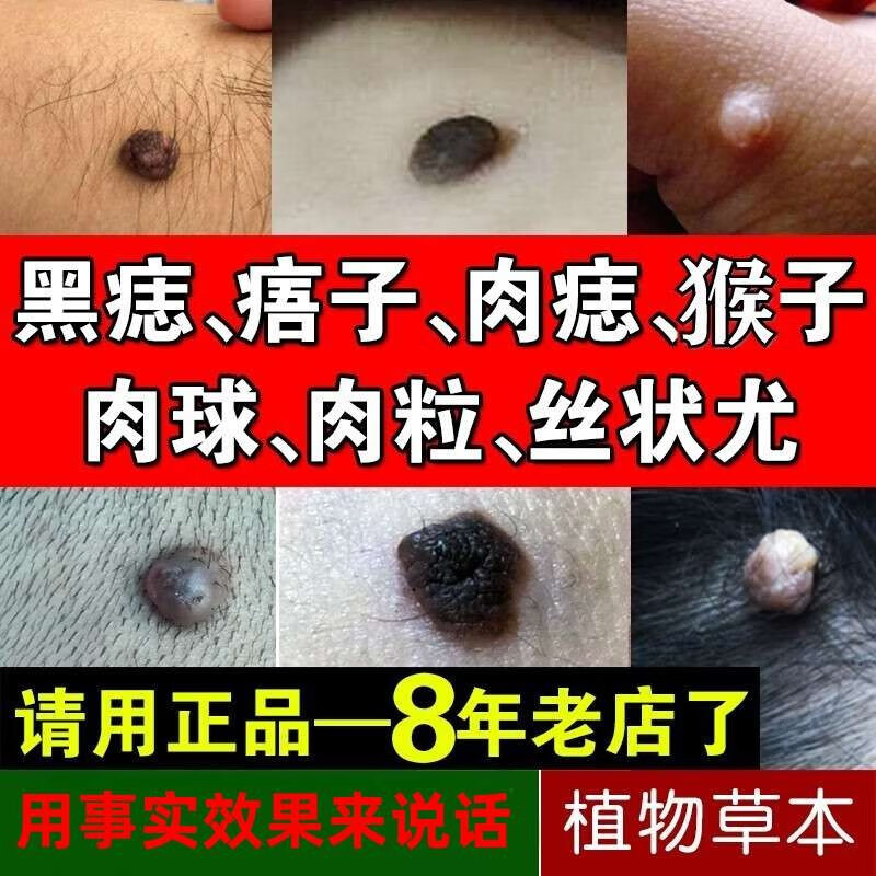 媗丝露遇见留香痦子去除祛肉瘤皮赘去除膏猴子脖子上长的小肉粒疙瘩