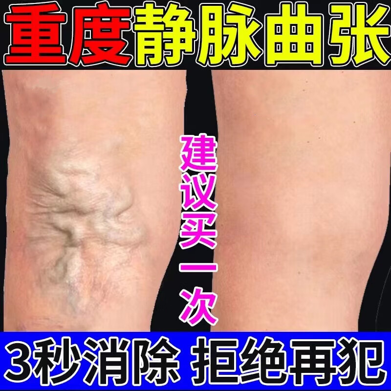 乐修静脉曲张舒冷敷凝胶蚯蚓腿膏青筋肿胀红血丝腿部外用静脉凸起专用