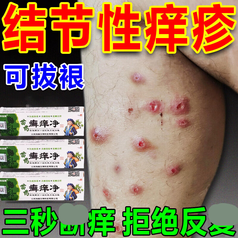 结节性痒疹治顽固硬疙瘩皮肤瘙痒止l痒神器全身痒外用膏 身痒外用膏