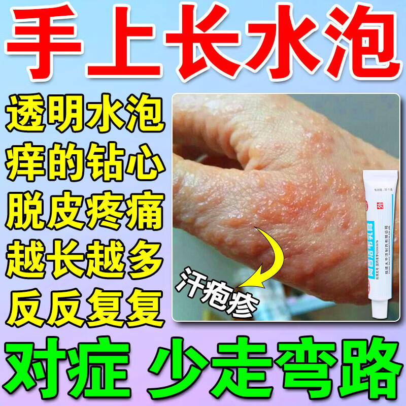 【手上反复痒起小水泡 治疱疹水泡湿疹】顽固型汗泡汗状泡疹软膏干裂