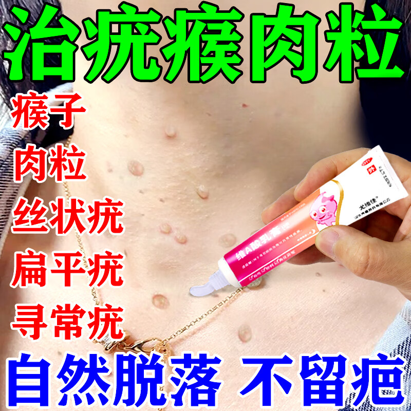瘊子丝状疣扁平疣去面部脖子上长的小肉粒疙瘩疣瘊皮肤用药维a酸乳膏