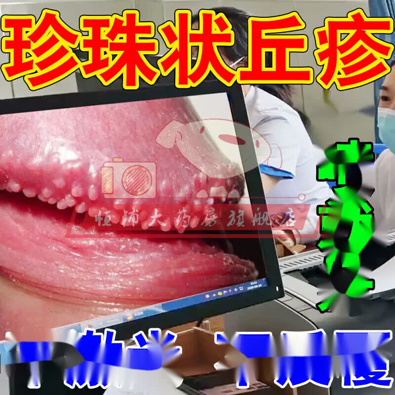龟炎清液可搭珍珠疹 珍珠状丘疹冠状沟珍珠粒疹男性生可搭龟可搭 一