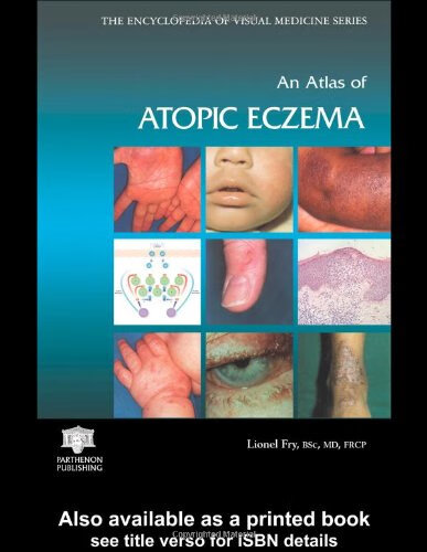 预订 an atlas of atopic eczema