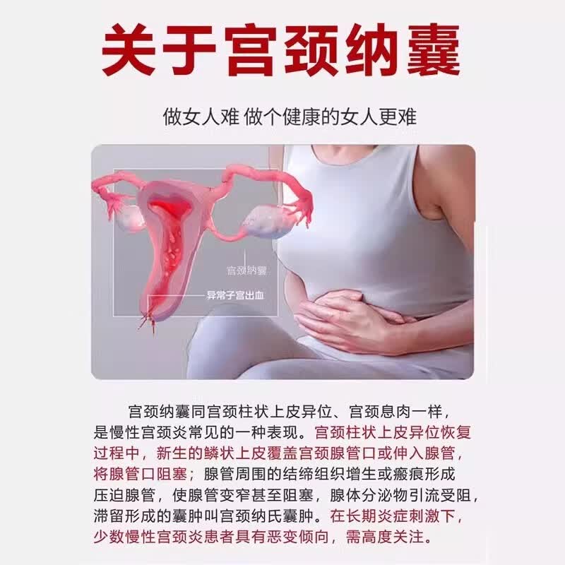 同仁堂宫颈囊肿纳氏囊肿凝胶用药子宫息肉宫颈肥大糜烂妇科凝胶 买三送二[共五盒]