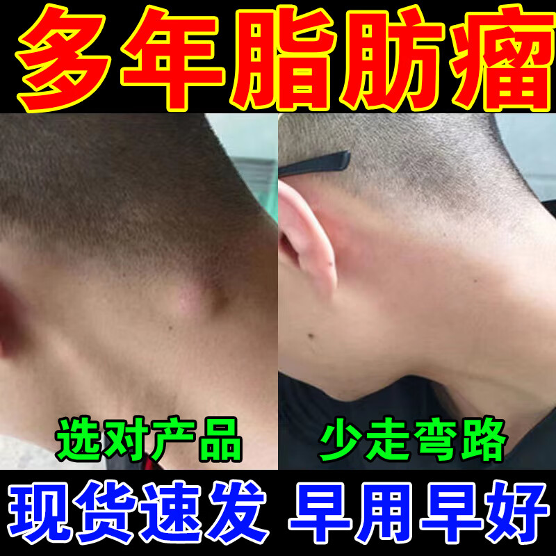 【官方】脂肪瘤膏神器硬块脂肪瘤36种皮下多发性脂脂肪瘤专用皮脂腺