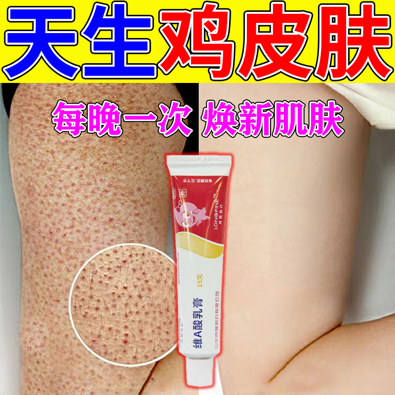 去鸡皮肤最有效的药膏测评（网上买的去鸡皮肤的药膏管用吗?）
