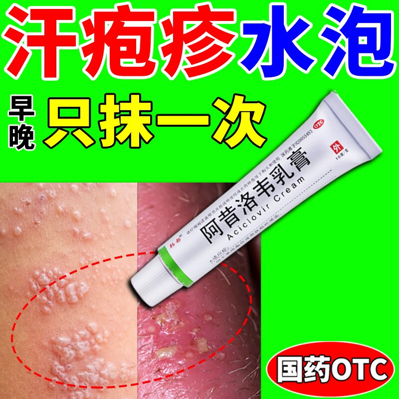 汗疱疹药膏手上小水泡脱皮手痒 汗疱疹抑菌膏嘴角水泡带状疱疹抗病毒