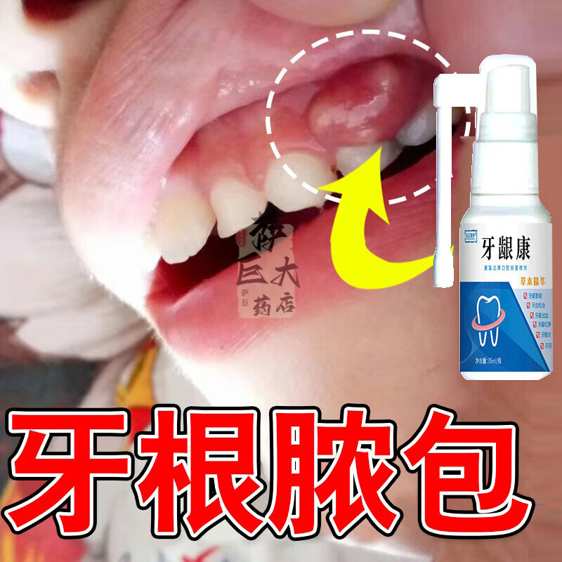 牙龈脓肿牙龈肿包牙根瘘管囊肿长脓包鼓包反复牙齿根尖周炎喷剂 买二