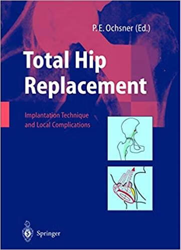预订total hip replacement: implantation technique an
