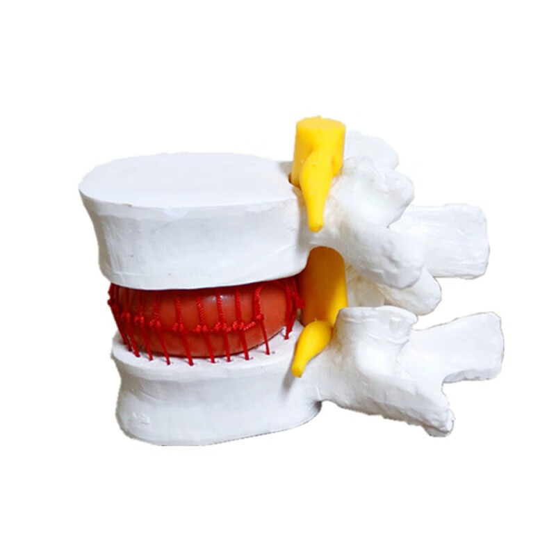 腰椎放大腰椎间盘受压演示模型人体脊柱脊椎骨病理演示关节骨骼解剖