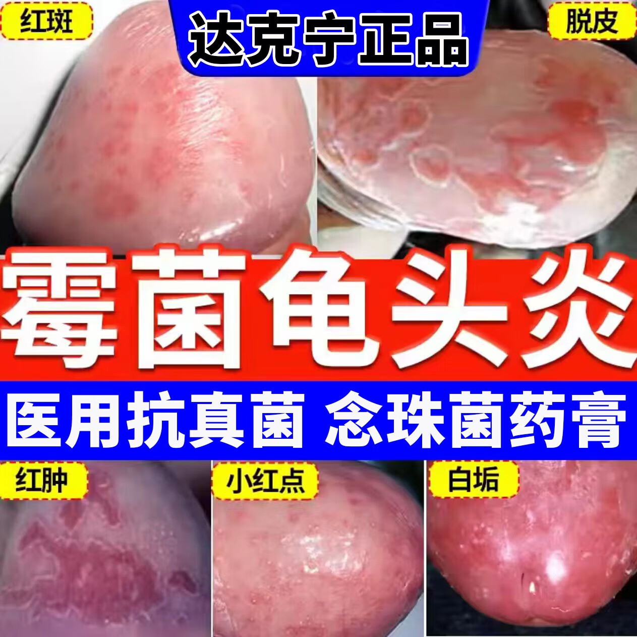 达克宁软膏私处 男性男人私处瘙痒止痒根药治念珠菌性引起的真菌感染