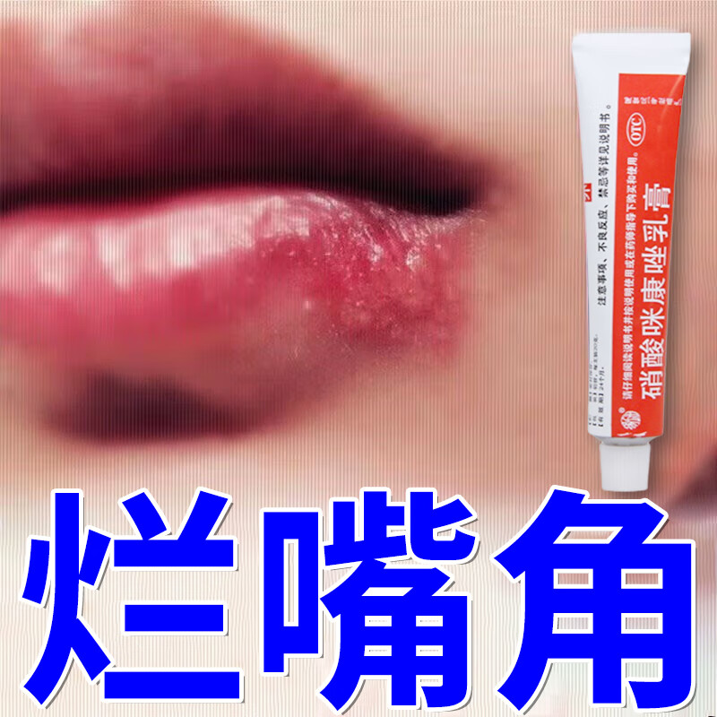 烂嘴角药膏 口角炎 嘴角起泡嘴唇上火起泡烂嘴角干裂肿痛 消炎止痒