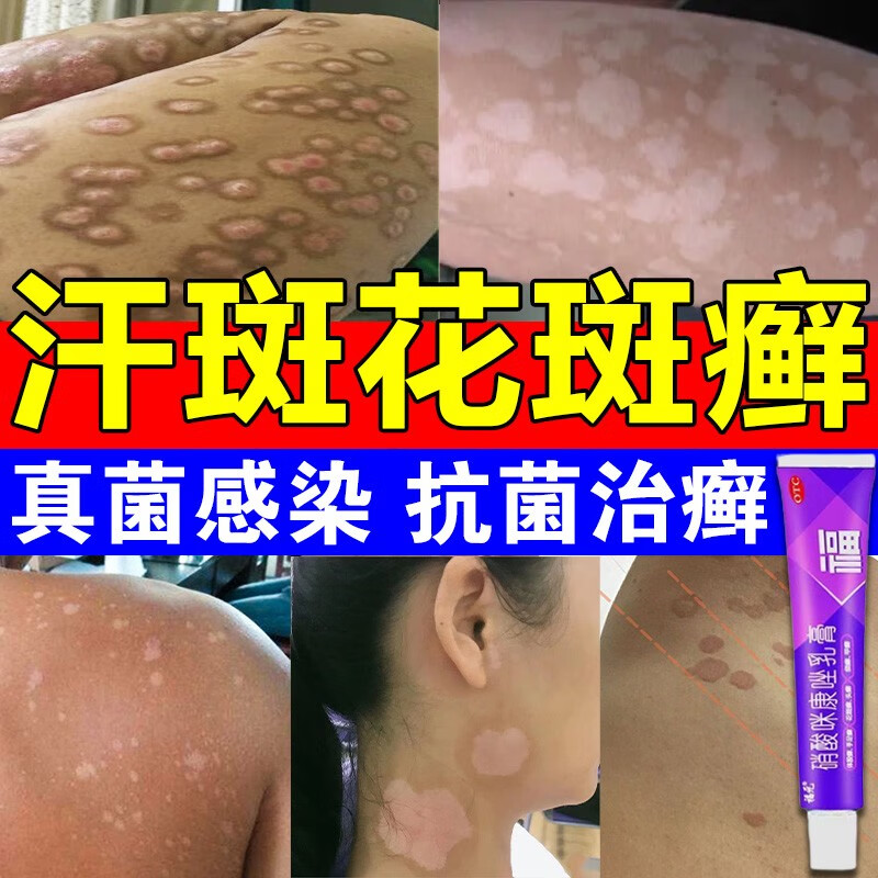 汗癣花斑癣专用药膏】专用祛汗斑 体癣 股癣 花斑癣 真菌感染福元硝酸